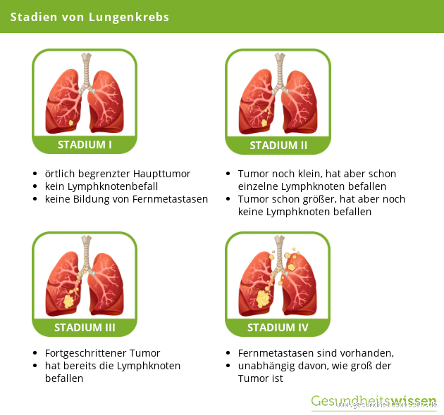 In welchem Stadium tut Lungenkrebs weh? Warnzeichen nicht ignorieren