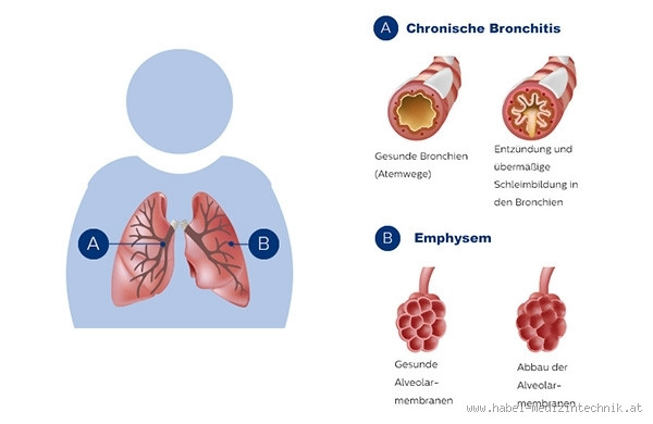 Ist COPD erblich bedingt? Was du wirklich wissen musst