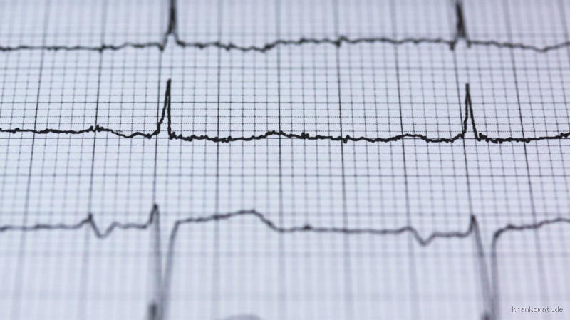 Ist ein Herzinfarkt immer im EKG sichtbar? Was du wissen solltest