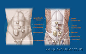 Kann die Bauchdecke von innen reißen? - Ursachen, Symptome und Prävention einer Bauchdeckenverletzung