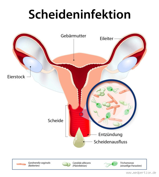 Kann eine Scheidenentzündung von selbst heilen? Alles, was du wissen musst