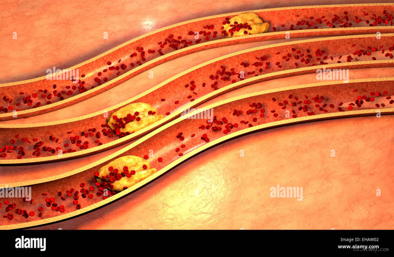 Kann man verstopfte Arterien heilen? Die Wahrheit über Plaque und Hoffnung