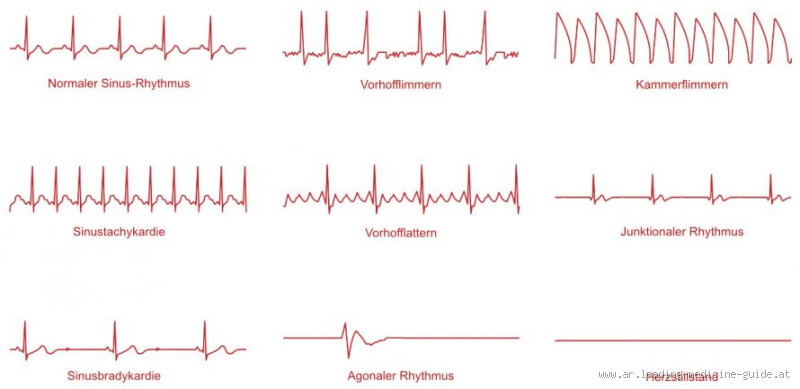 Können Herzrhythmusstörungen von alleine wieder verschwinden?