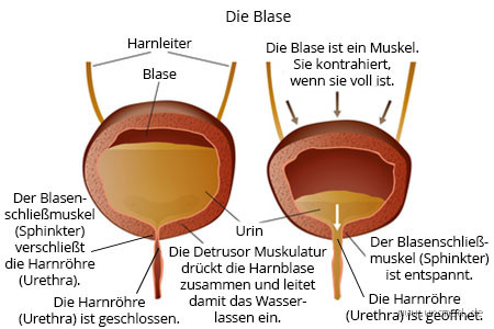 Warum ist zu viel Restharn gefährlich? Risiken und Folgen