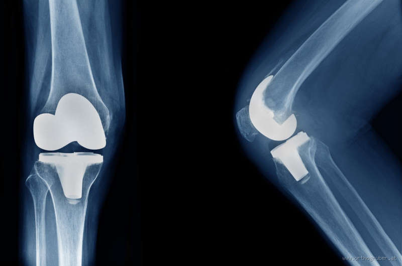 Was kann man mit einem künstlichen Knie nicht mehr machen? Einschränkungen &amp; Tipps