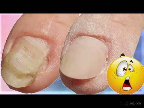 Was passiert, wenn die Nagelwurzel kaputt ist?