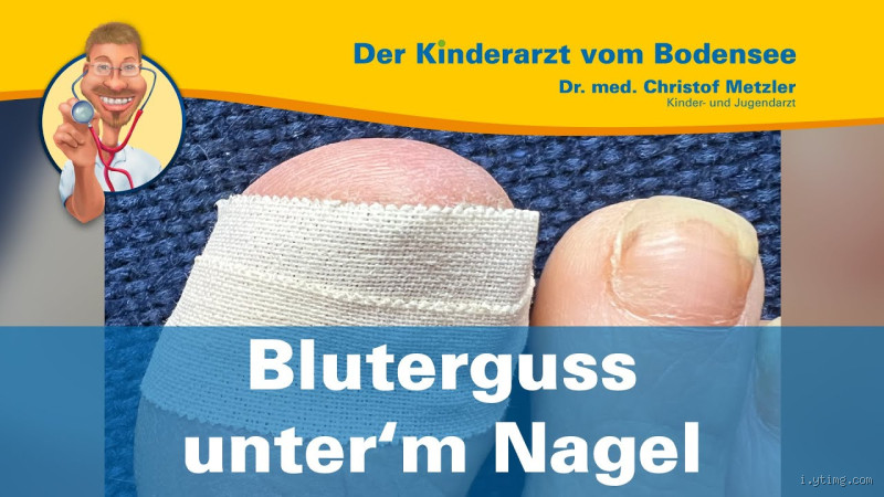 Was tun bei Bluterguss unter dem Nagel? Tipps und Tricks zur Behandlung