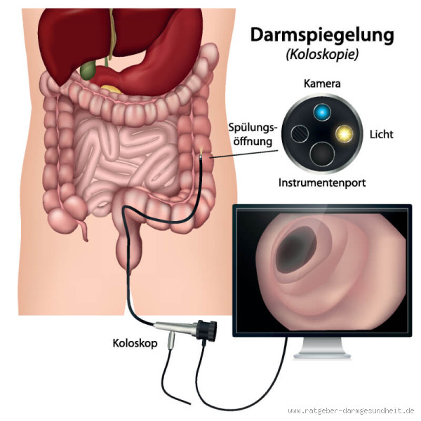 Wie geht’s nach Darm OP? So läuft die Erholung wirklich ab