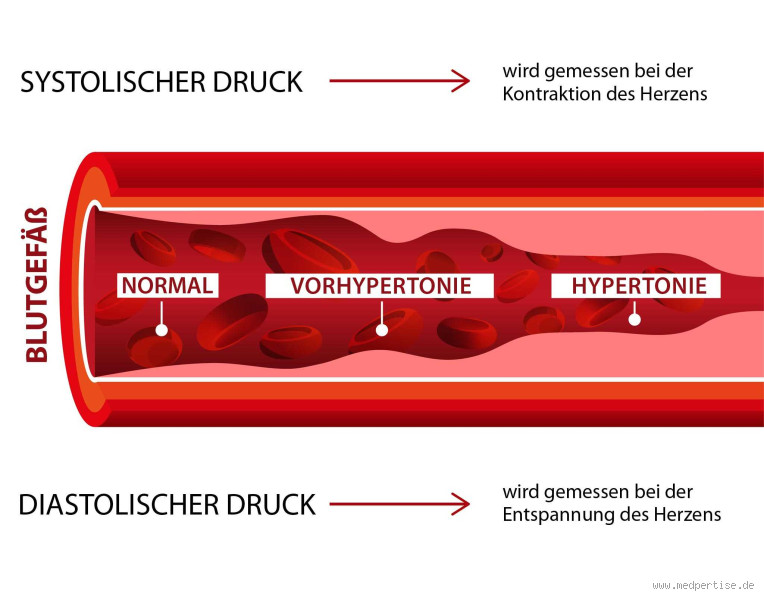 Wie hoch ist der Blutdruck bei einem Herzinfarkt? Wichtige Informationen