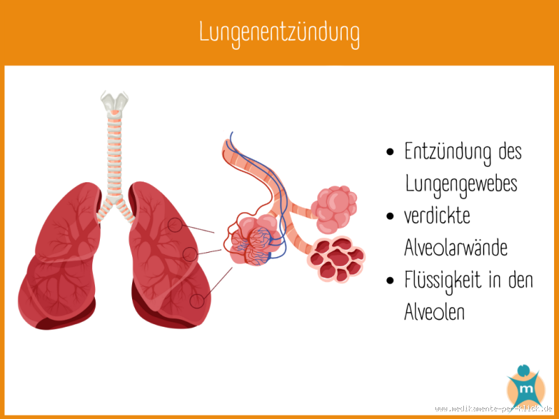 Wie hoch ist der CRP bei einer Lungenentzündung?