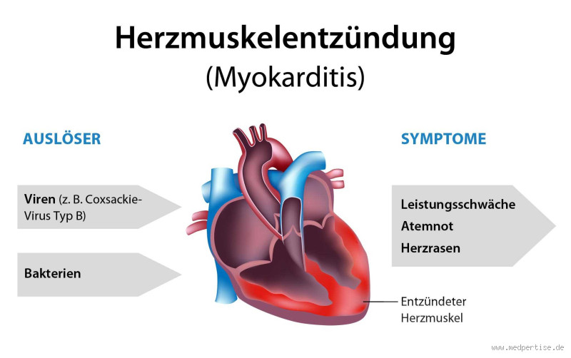 Wie kündigt sich eine Herzmuskelentzündung an? Symptome verstehen