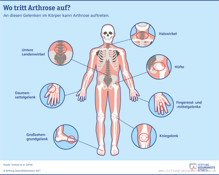 Wie lange dauert eine entzündete Arthrose? Fakten & Hilfe