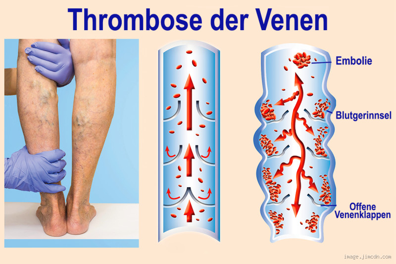 Wie lange dauert Thrombose in der Wade? Wichtige Informationen zur Heilung