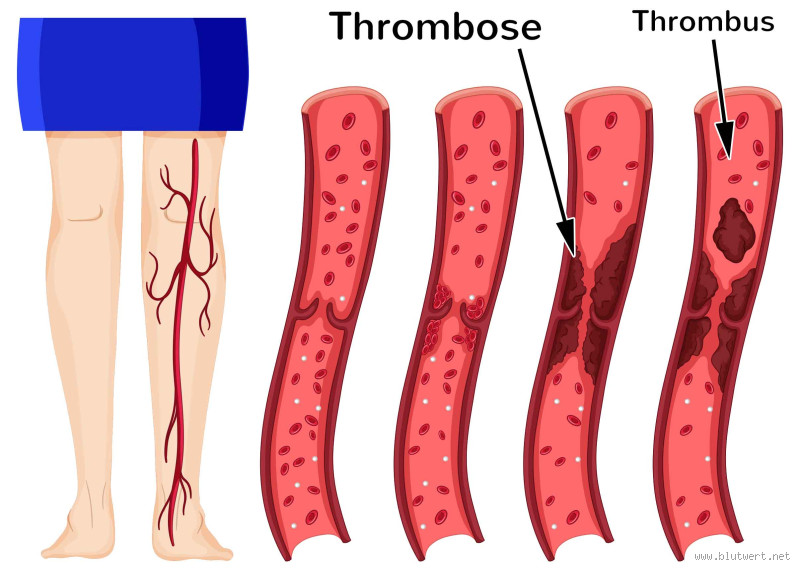 Wie merke ich ob ich eine Thrombose im Bein habe?