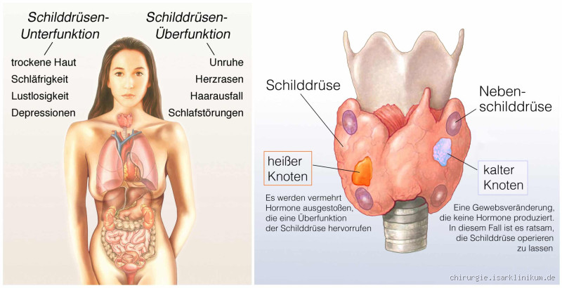 Wie merkt man, dass mit der Schilddrüse etwas nicht stimmt?