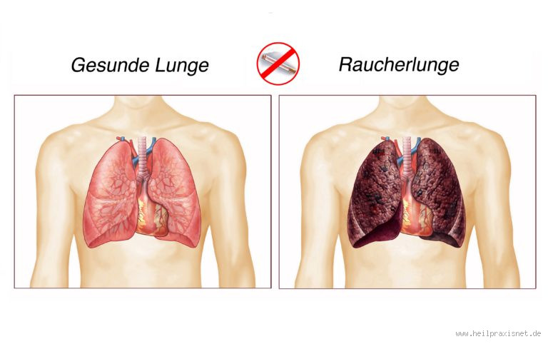Wie stellt man eine Raucherlunge fest? Einblick in Symptome und Diagnose