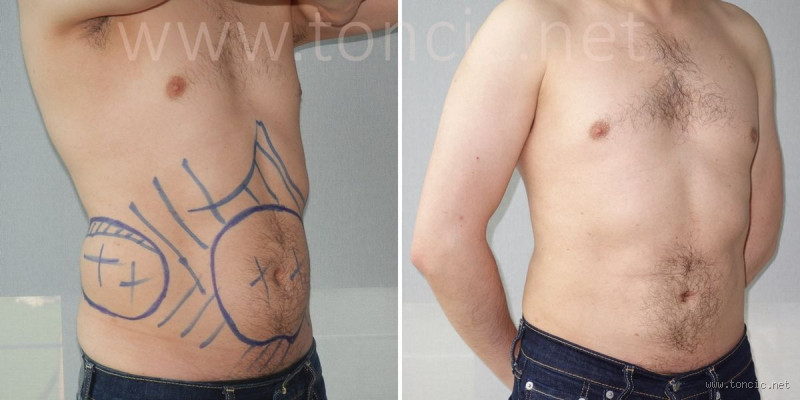 Kann man überschüssige Haut am Bauch Wegtrainieren?