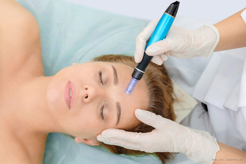 Wie oft sollte man Microneedling im Jahr durchführen?